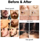Matte Black Dermaroller 0.5mm Derma Roller para Barba y Cabello