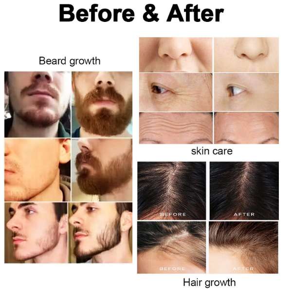 Matte Black Dermaroller 0.5mm Derma Roller para Barba y Cabello