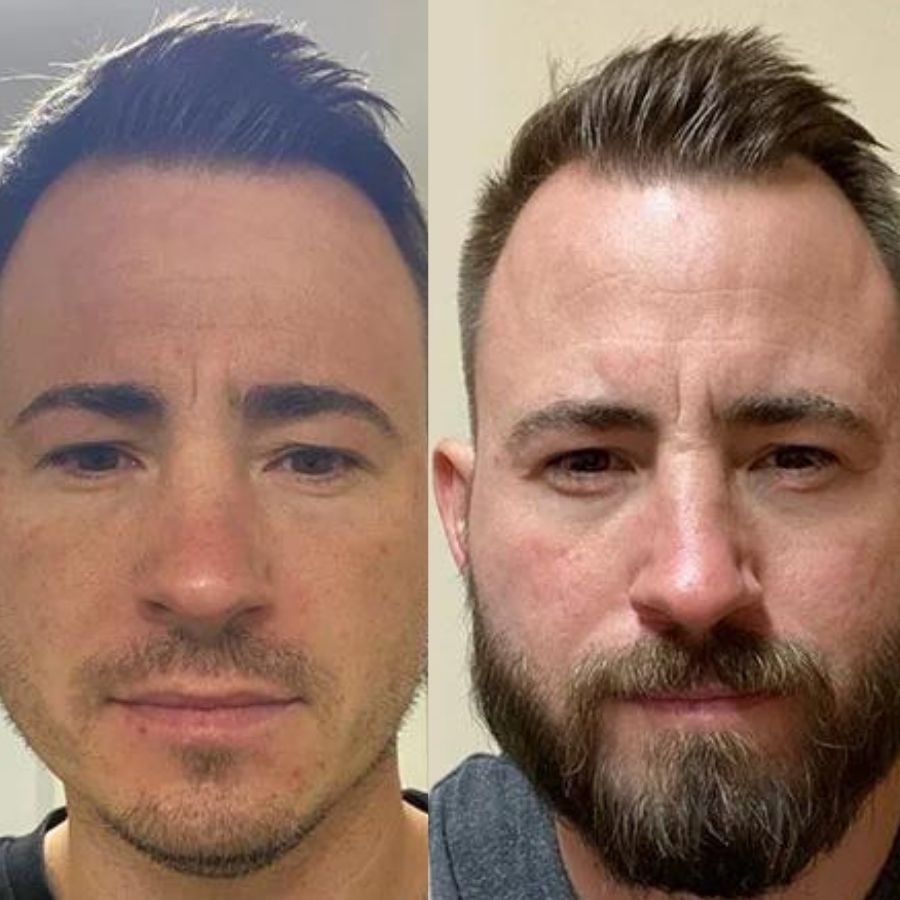 Bálsamo Minoxidil 20% para Barba y Bigote