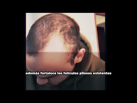 Shampoo con minoxidil 5% 500 ml - anticaída - crecimiento capilar